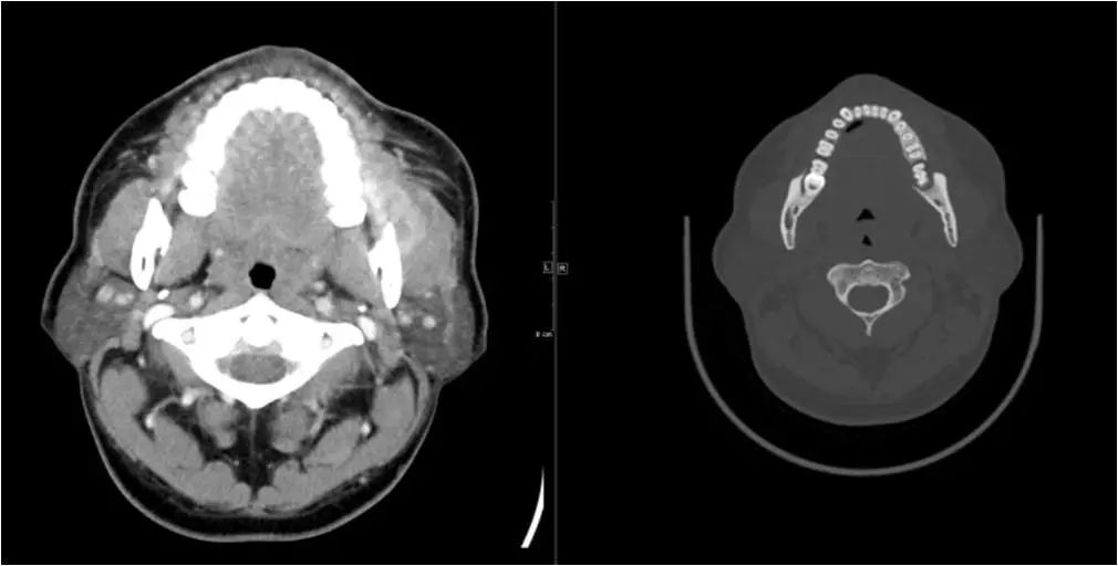 颌面部间隙感染影像诊断及各间隙解剖-12