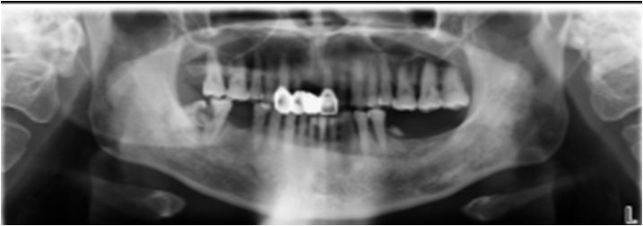 颌面部间隙感染影像诊断及各间隙解剖-15