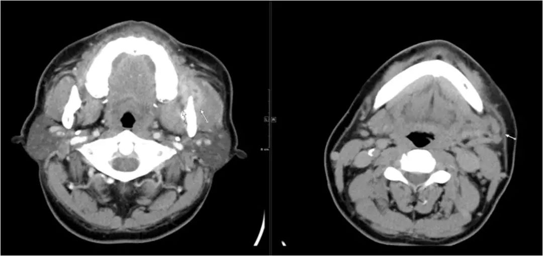 颌面部间隙感染影像诊断及各间隙解剖-14