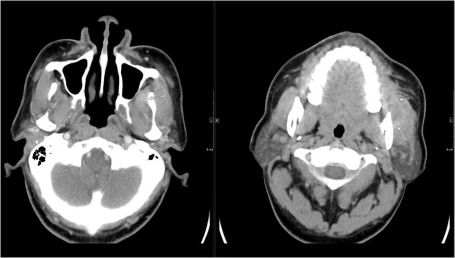 颌面部间隙感染影像诊断及各间隙解剖-13