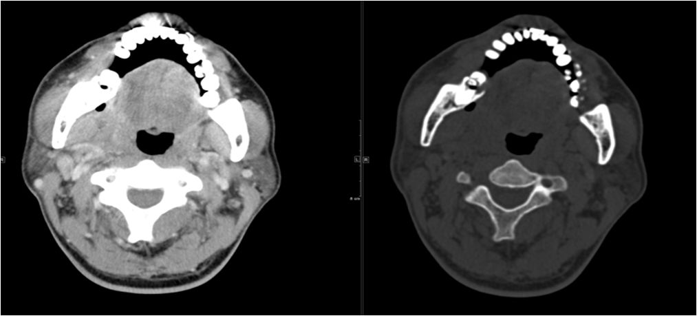 颌面部间隙感染影像诊断及各间隙解剖-16
