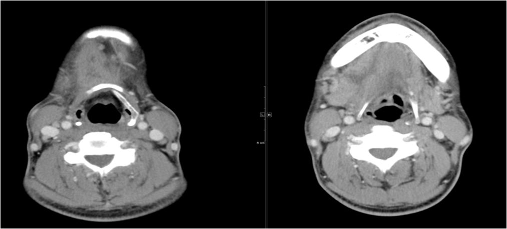 颌面部间隙感染影像诊断及各间隙解剖-17