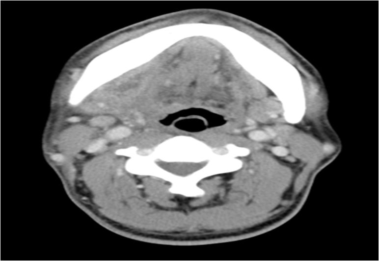 颌面部间隙感染影像诊断及各间隙解剖-18