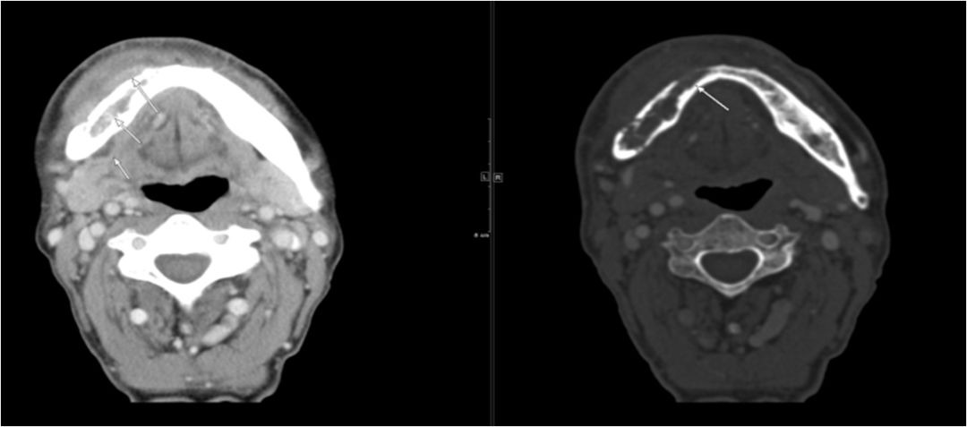 颌面部间隙感染影像诊断及各间隙解剖-19