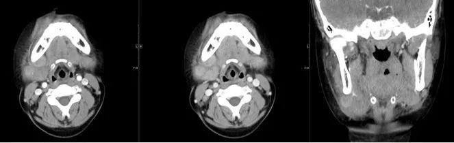 颌面部间隙感染影像诊断及各间隙解剖-20