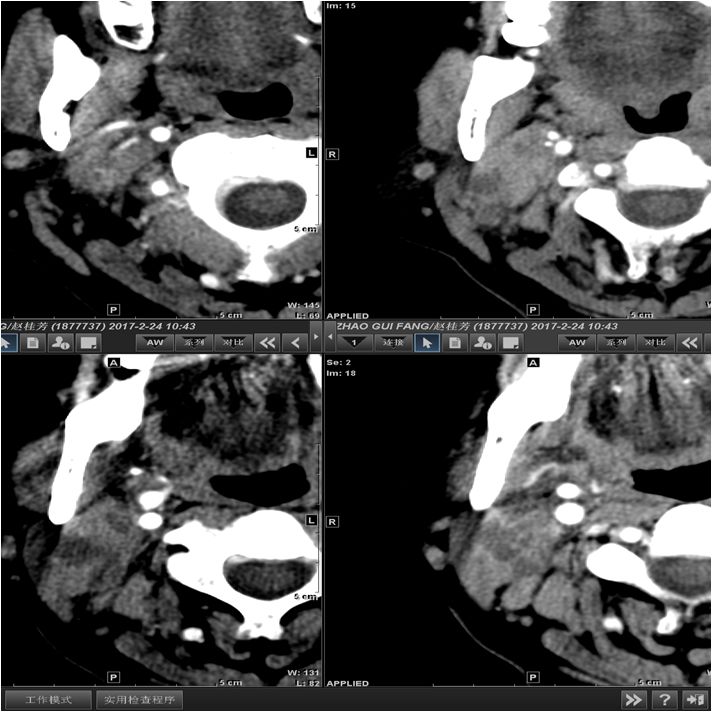 颌面部间隙感染影像诊断及各间隙解剖-21