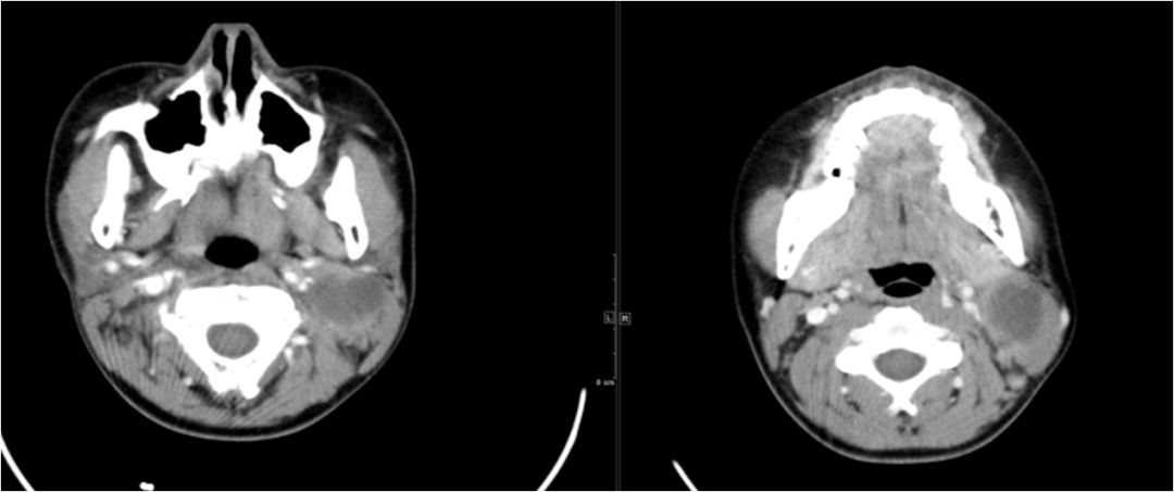 颌面部间隙感染影像诊断及各间隙解剖-24