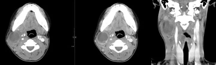 颌面部间隙感染影像诊断及各间隙解剖-25