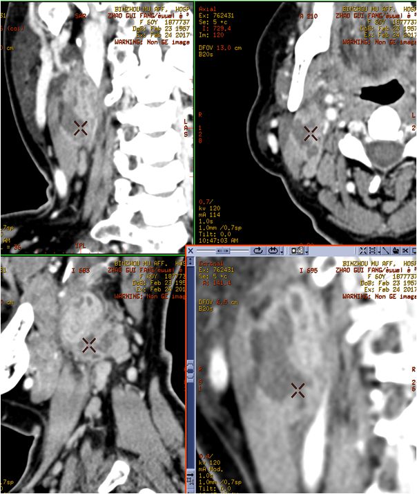 颌面部间隙感染影像诊断及各间隙解剖-23