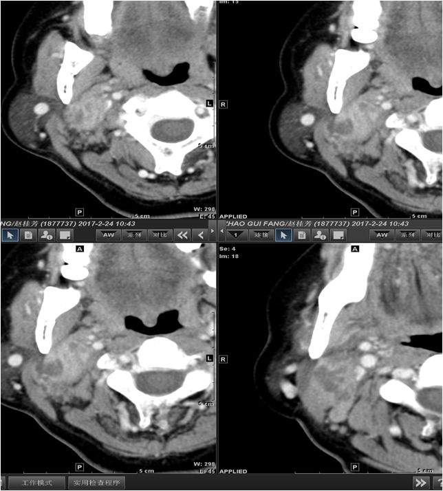 颌面部间隙感染影像诊断及各间隙解剖-22
