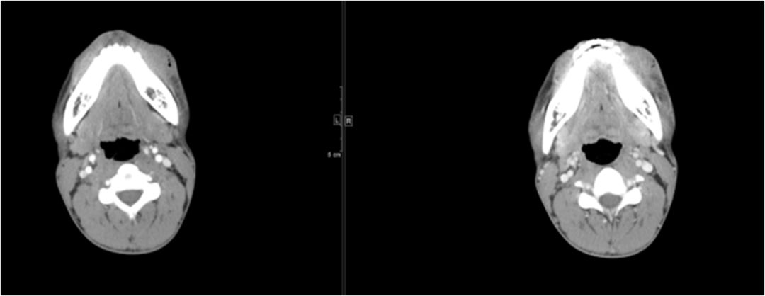 颌面部间隙感染影像诊断及各间隙解剖-26