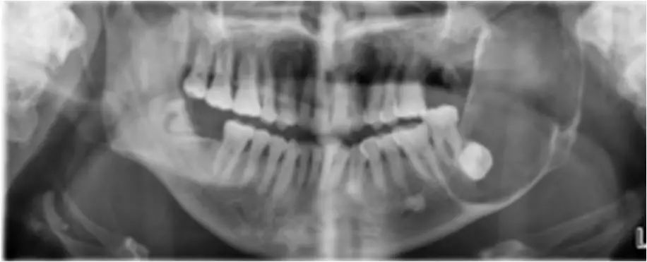 颌面部间隙感染影像诊断及各间隙解剖-27