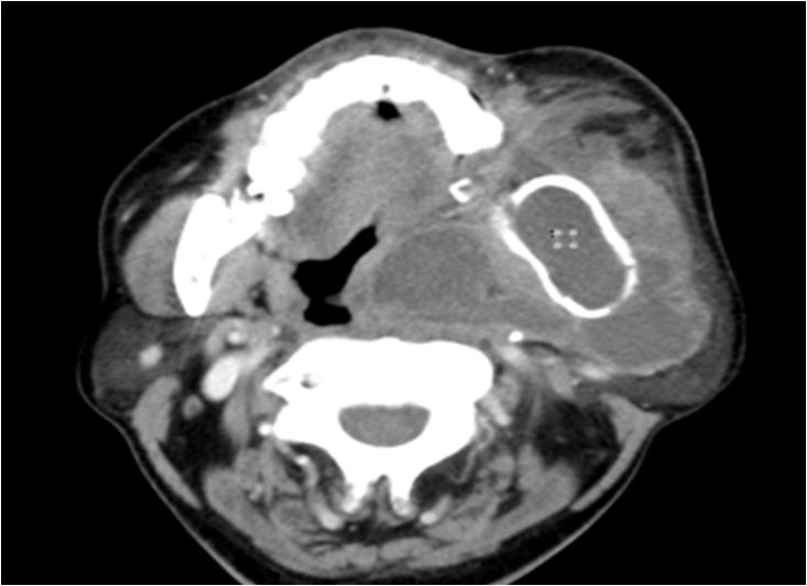 颌面部间隙感染影像诊断及各间隙解剖-29