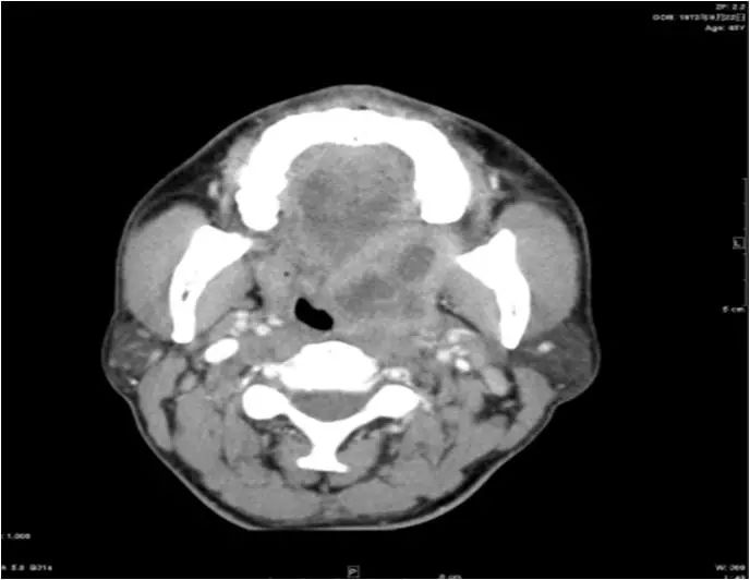 颌面部间隙感染影像诊断及各间隙解剖-30