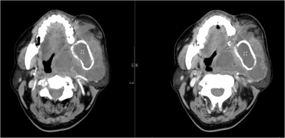 颌面部间隙感染影像诊断及各间隙解剖-28