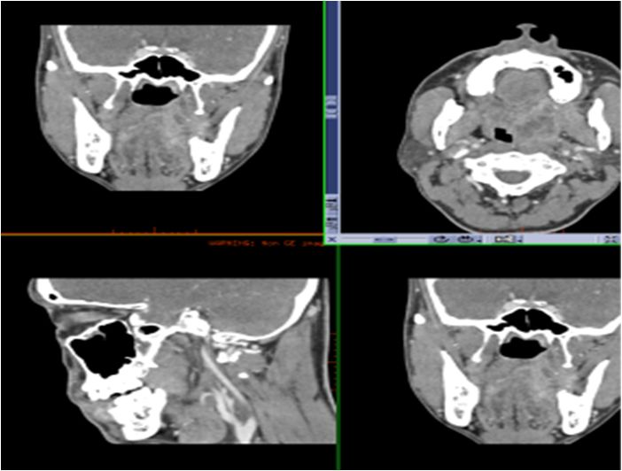 颌面部间隙感染影像诊断及各间隙解剖-31