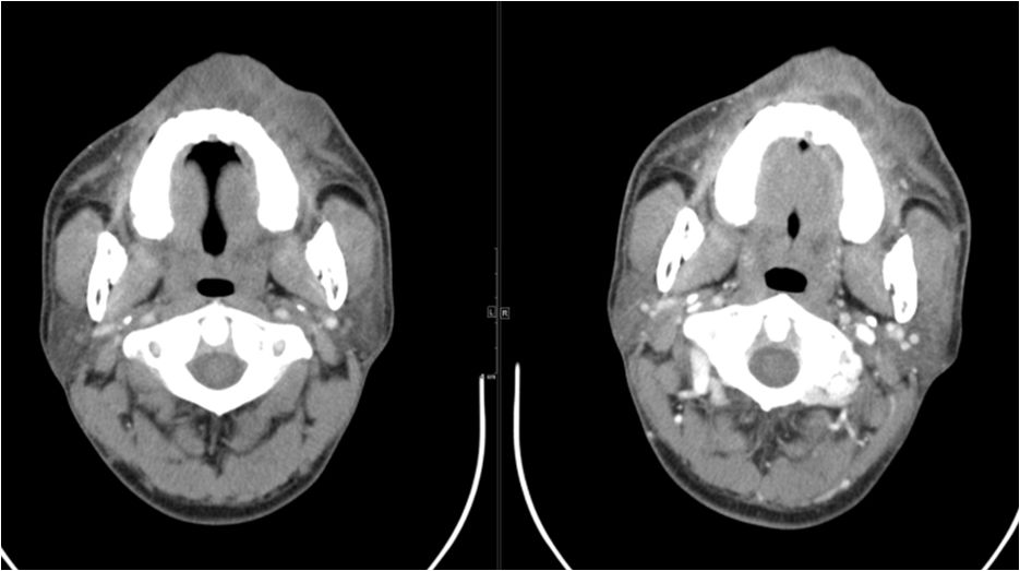 颌面部间隙感染影像诊断及各间隙解剖-32