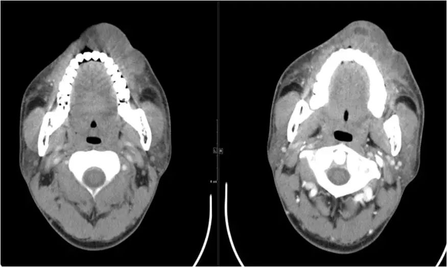 颌面部间隙感染影像诊断及各间隙解剖-33