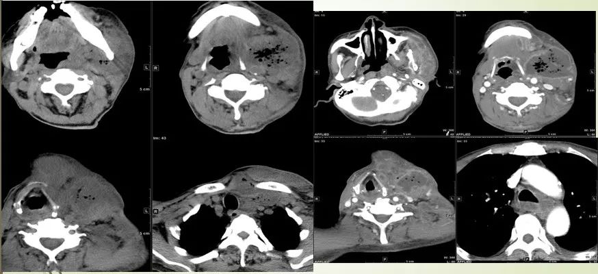 颌面部间隙感染影像诊断及各间隙解剖-34