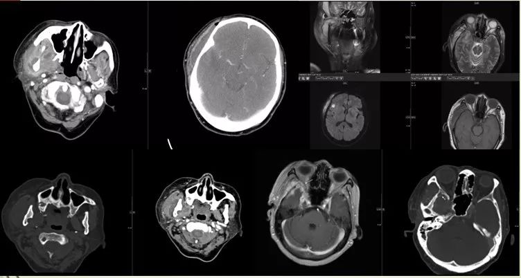 颌面部间隙感染影像诊断及各间隙解剖-36