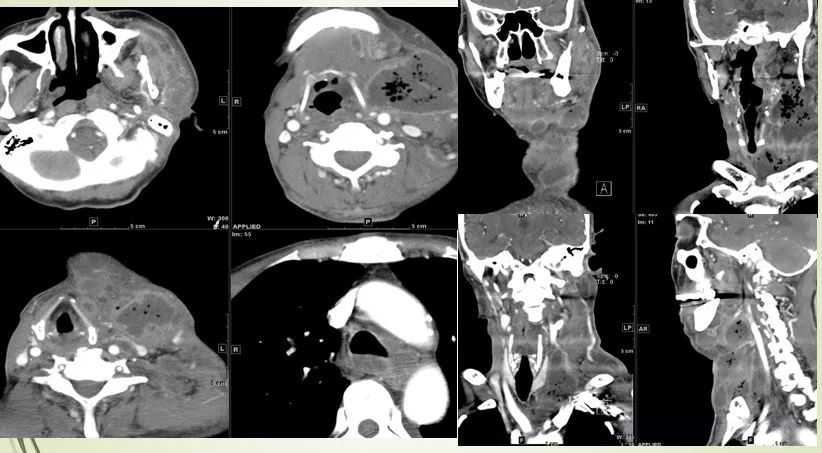 颌面部间隙感染影像诊断及各间隙解剖-35