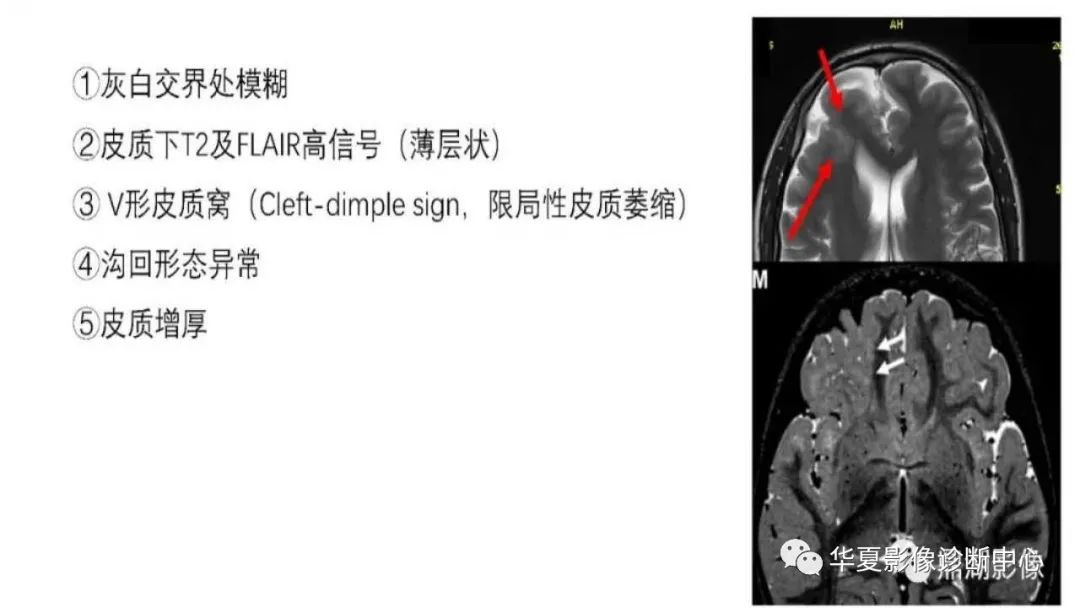 MOGHE的MRI诊断与鉴别诊断-4