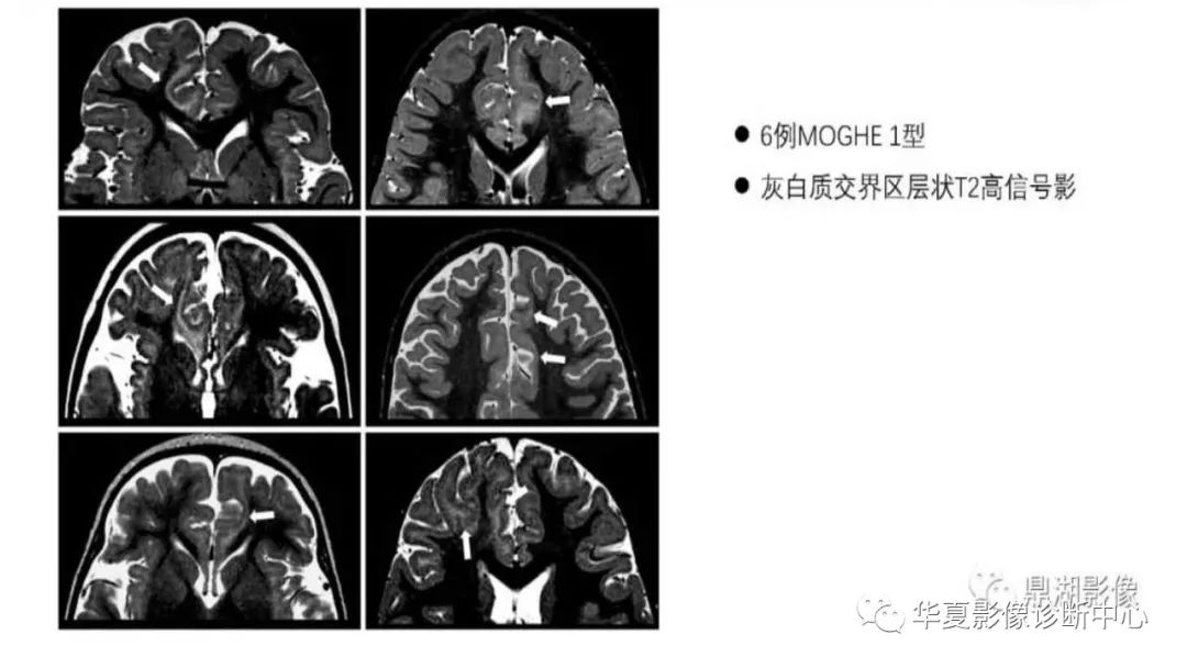 MOGHE的MRI诊断与鉴别诊断-6