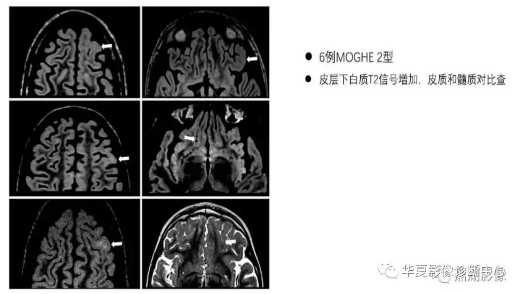 MOGHE的MRI诊断与鉴别诊断-7