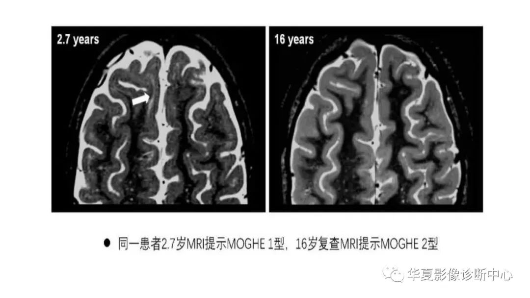 MOGHE的MRI诊断与鉴别诊断-8