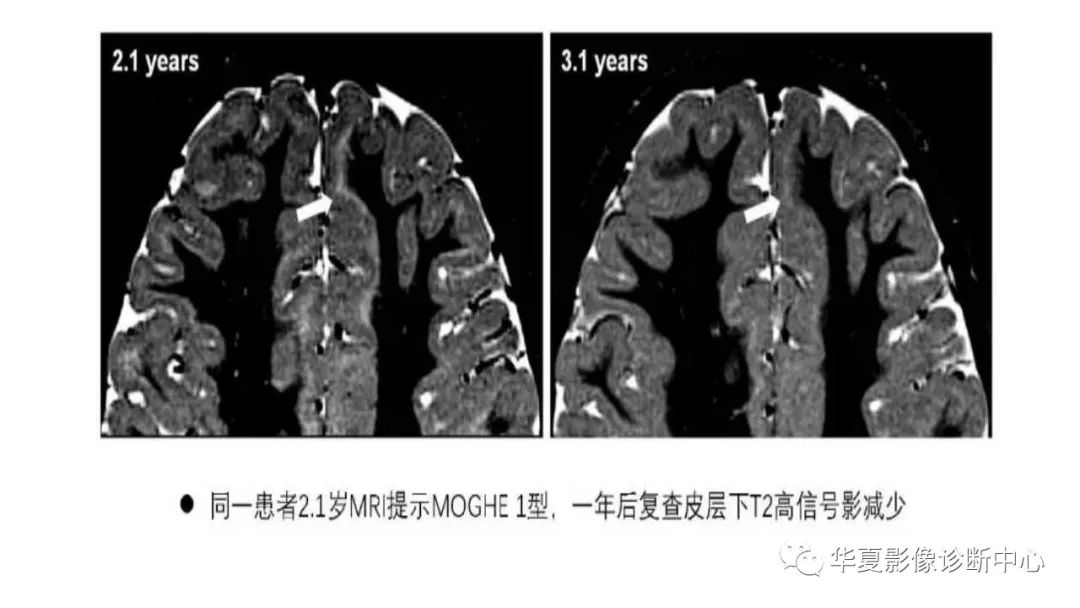 MOGHE的MRI诊断与鉴别诊断-9
