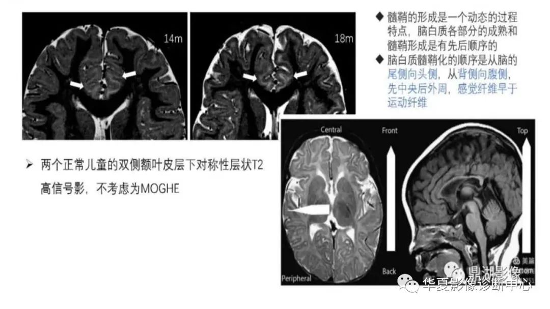 MOGHE的MRI诊断与鉴别诊断-11