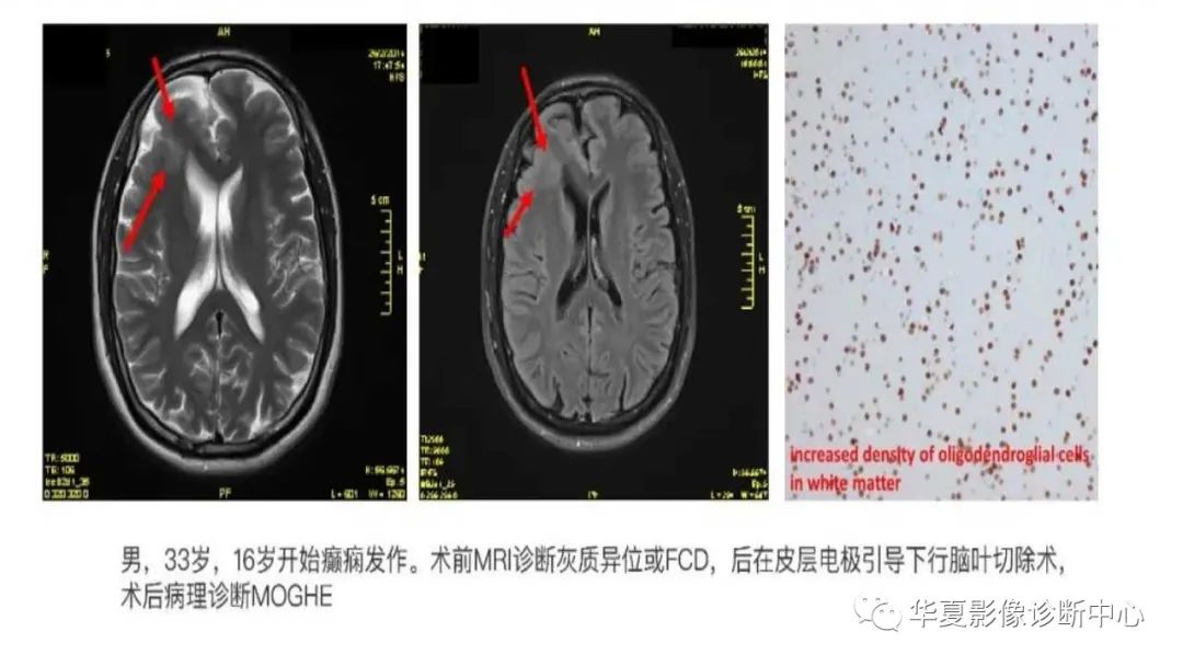 MOGHE的MRI诊断与鉴别诊断-13