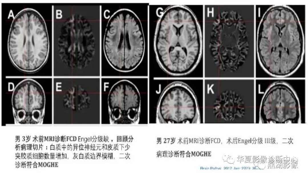 MOGHE的MRI诊断与鉴别诊断-12