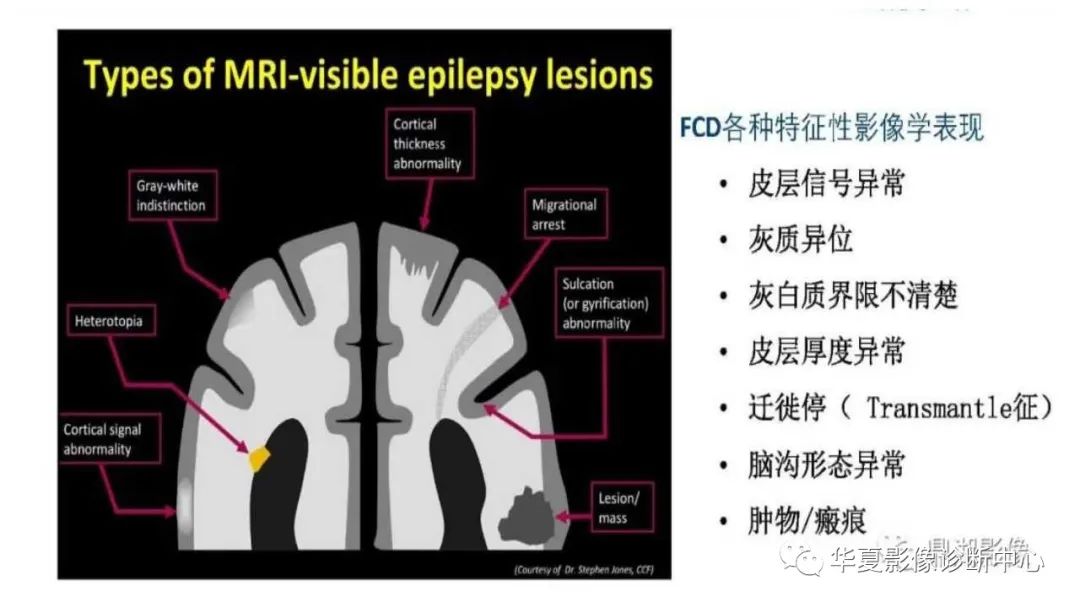 MOGHE的MRI诊断与鉴别诊断-17