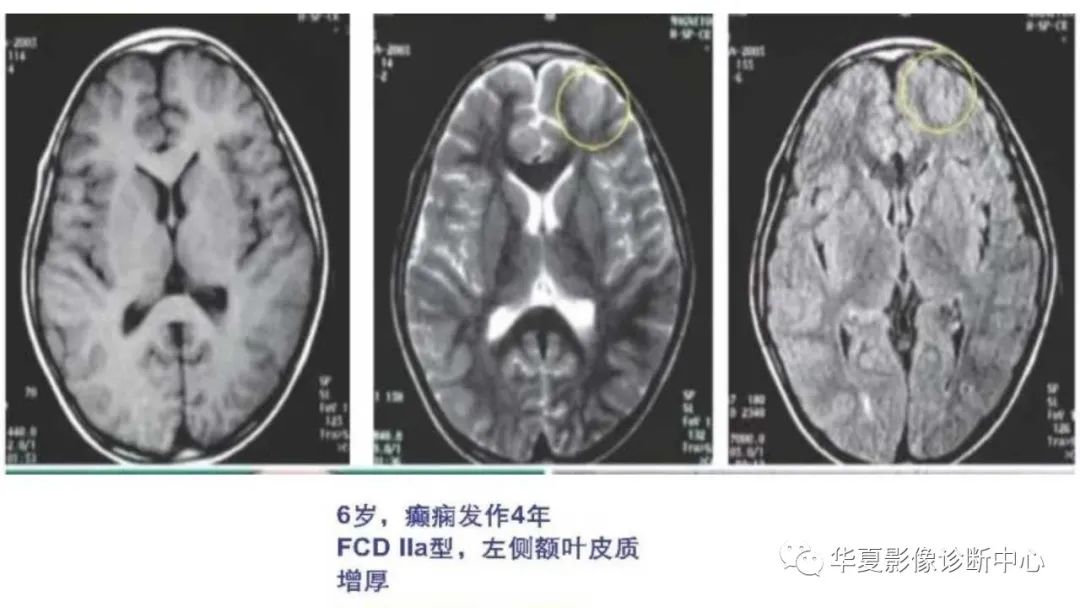 MOGHE的MRI诊断与鉴别诊断-19