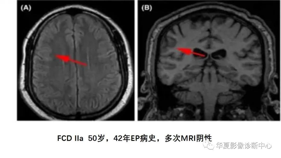 MOGHE的MRI诊断与鉴别诊断-20