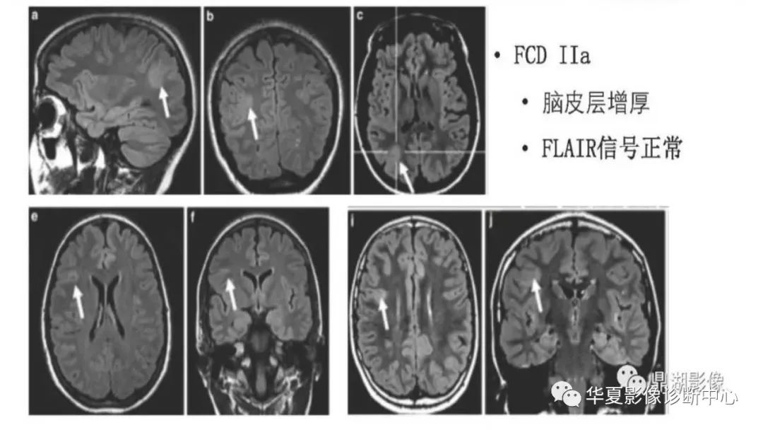 MOGHE的MRI诊断与鉴别诊断-21