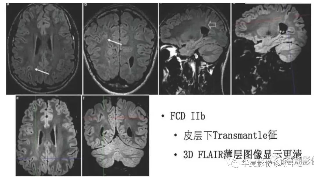 MOGHE的MRI诊断与鉴别诊断-23