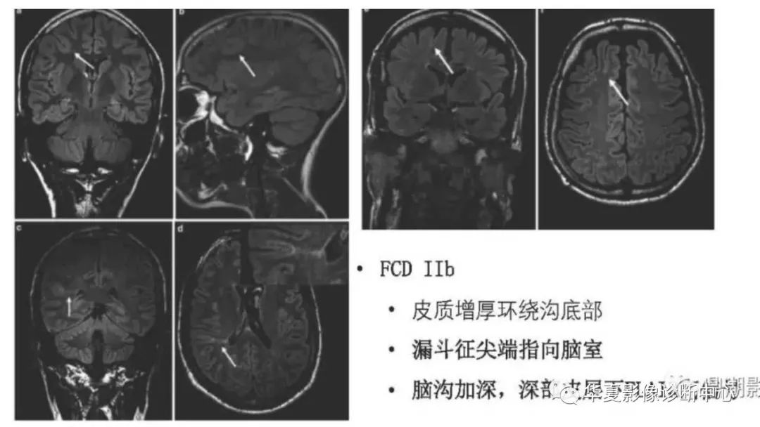 MOGHE的MRI诊断与鉴别诊断-24