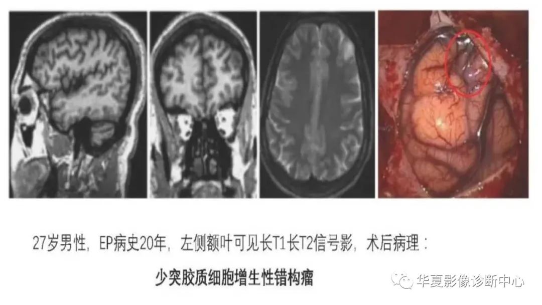 MOGHE的MRI诊断与鉴别诊断-25