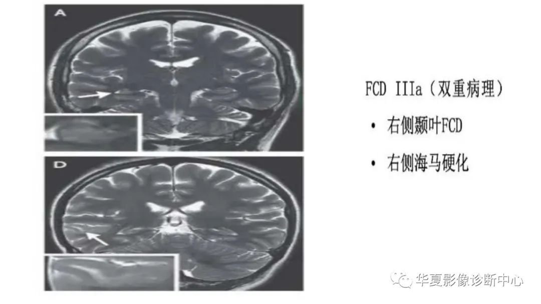 MOGHE的MRI诊断与鉴别诊断-26