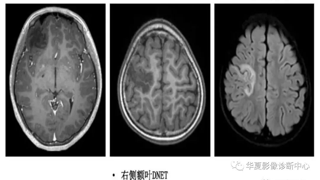 MOGHE的MRI诊断与鉴别诊断-28