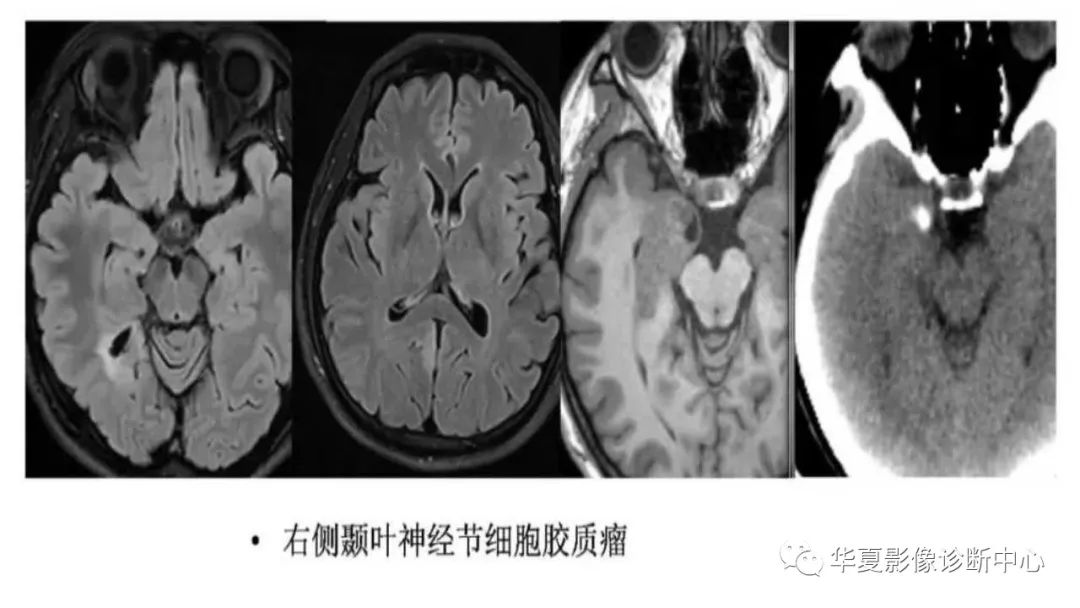 MOGHE的MRI诊断与鉴别诊断-27