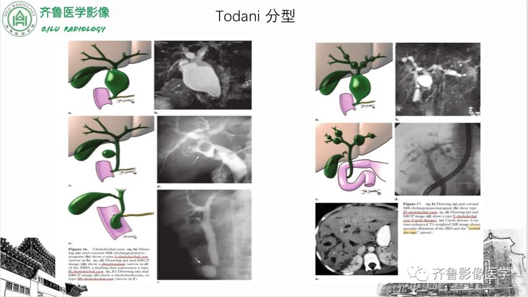 【PPT】先天性胆管扩张症-11
