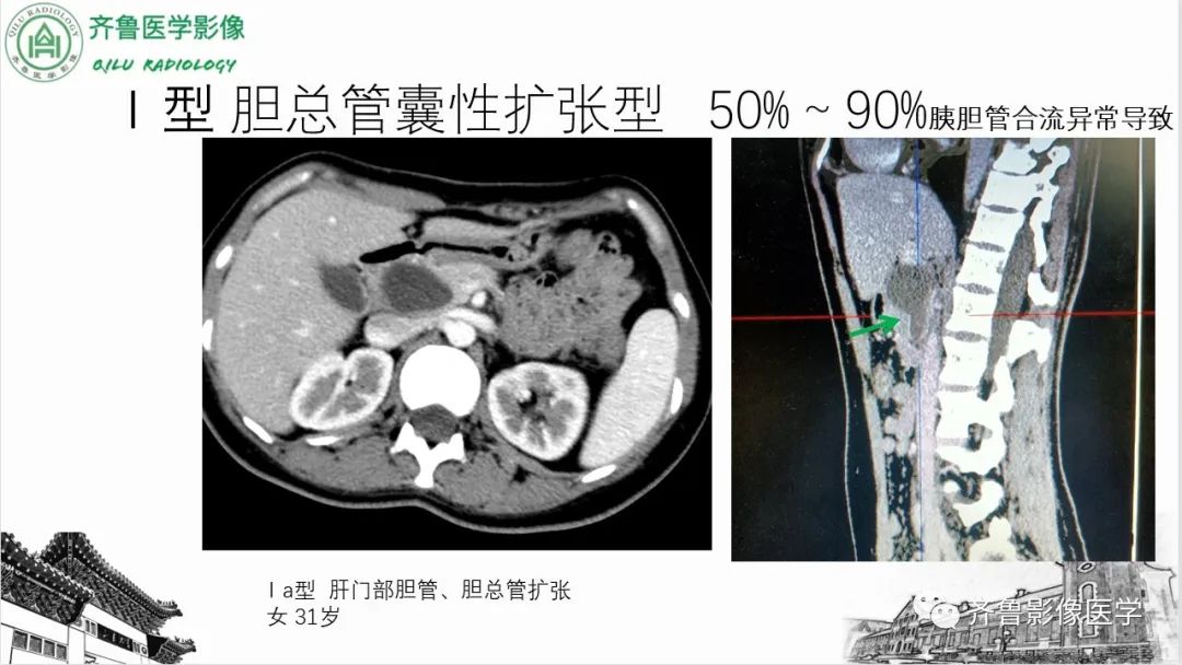 【PPT】先天性胆管扩张症-12