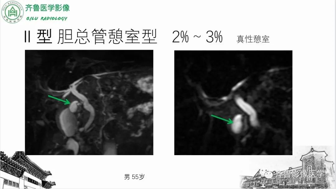 【PPT】先天性胆管扩张症-14
