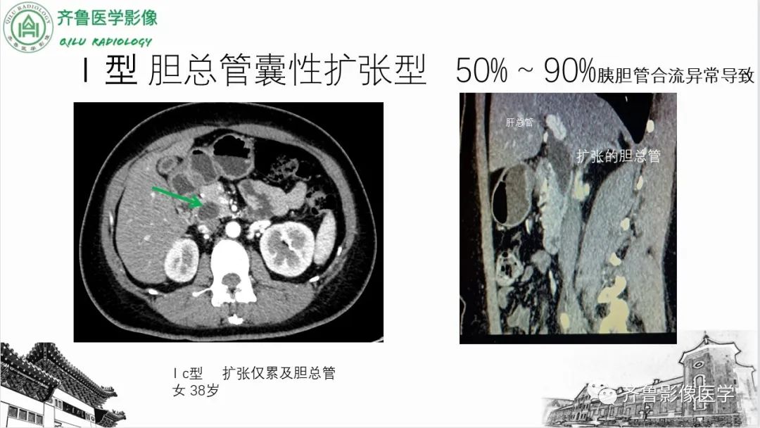 【PPT】先天性胆管扩张症-13