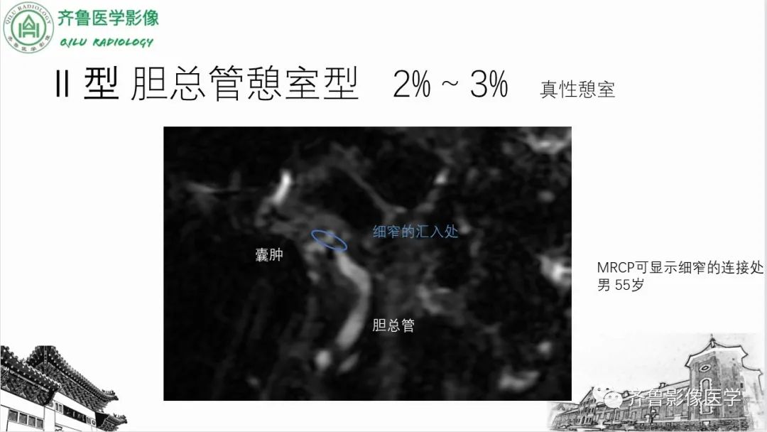 【PPT】先天性胆管扩张症-15