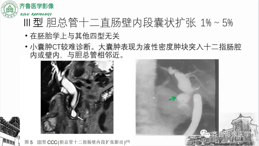 【PPT】先天性胆管扩张症-16