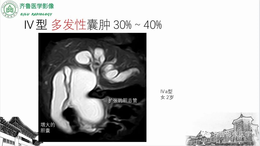 【PPT】先天性胆管扩张症-17